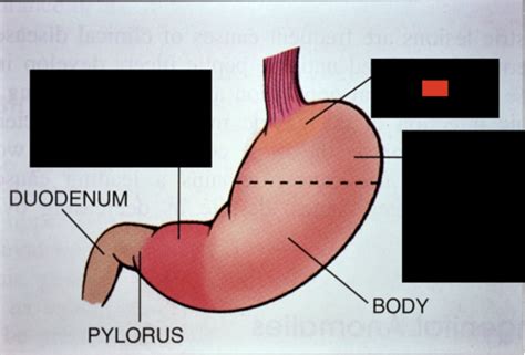 Pathology Gastric Ulcers Flashcards Quizlet