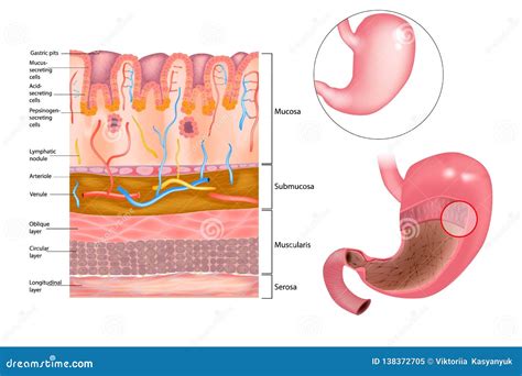 Mucosa Of Stomach With Peptic Ulcer And Bacterium Helicobacter Pylori Royalty-Free Cartoon ...