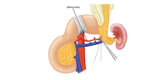 Distal Pancreatectomy Florida Center For Pancreas Diseases