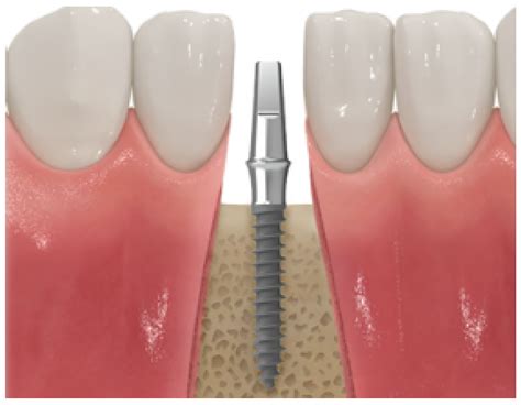 Stress Distribution Analysis Of Threaded Implants For Digital Dentistry