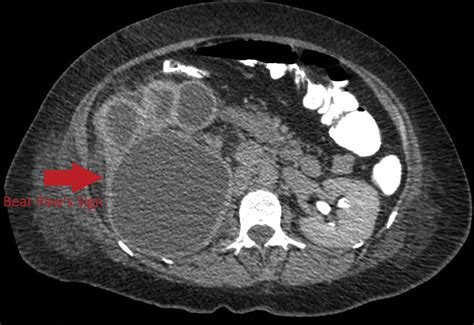 Bear S Paw Sign A Classic Presentation Of Xanthogranulomatous