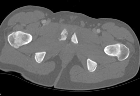 Fracture Of The Right Superior And Inferior Pubic Ramus With Negative Angiogram