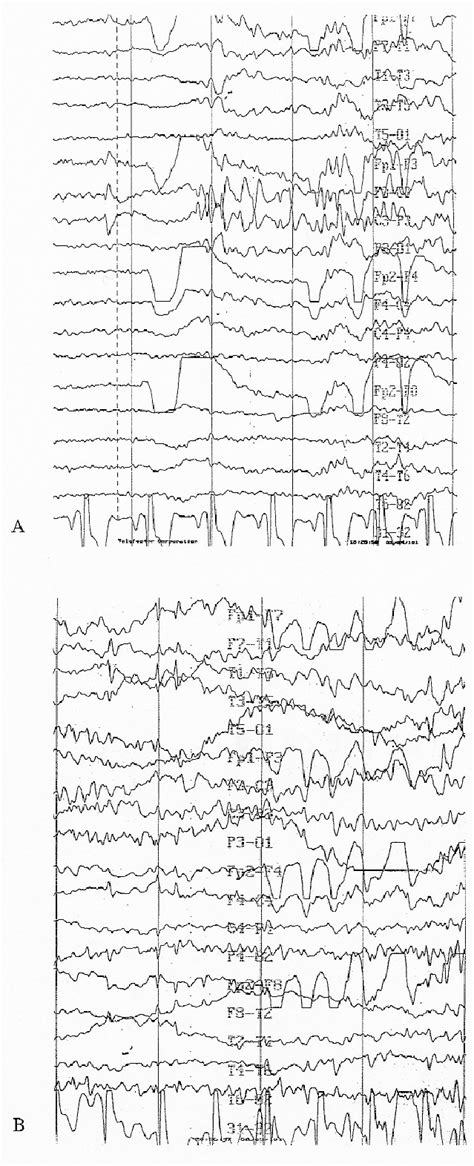 Eeg 1 The Beginning A And Spreading B Of The Seizure In Scalp