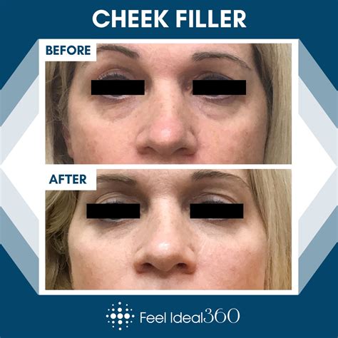 Cheek Filler Before And After Feel Ideal Med Spa Southlake Tx