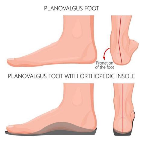 Flat Footed 5 Problems Faced By People With Fallen Arches Premier Hot