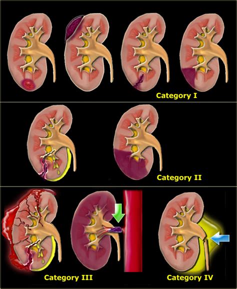 Renal Trauma Grading Radiology