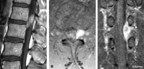 Herniated Lumbar Disk Sequestered Between The Internal And External