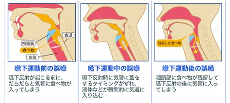 日本メディカルニュートリション協議会 摂食・嚥下障害website