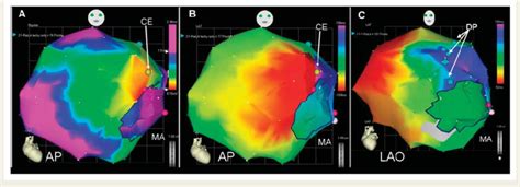 Electroanatomical Mapping Of The LA During Tachycardia A And B And