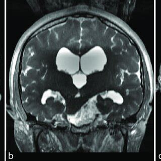 Preoperative Axial T Weighted Enhanced Magnetic Resonance Imaging