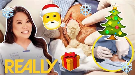 Dr Lees Most Intense Cyst And Bump Removals With Christmas Music Dr Pimple Popper Youtube