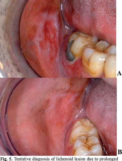 Figure From Oral Lichen Planus And Oral Lichenoid Lesions A Critical