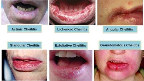 Cheilitis Skin Diseases Inflammatory Bowel Disease Vaseline Lip Therapy