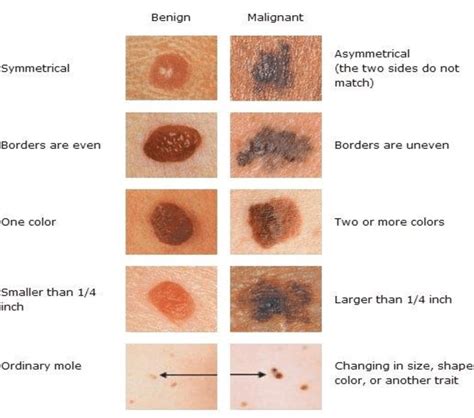 Benign Nevus Vs Melanoma