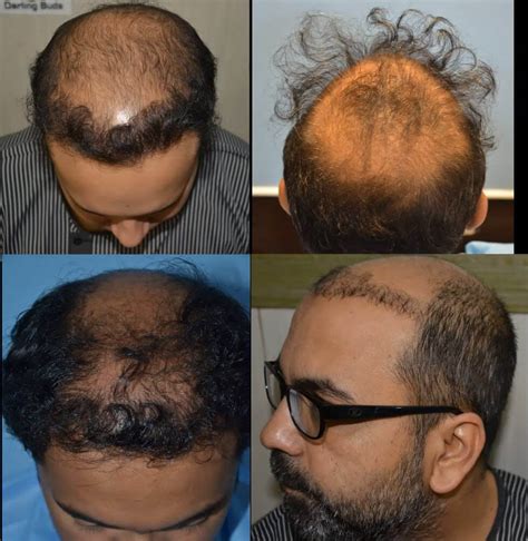 20 Hair Transplant Goes Wrong Orianemarko