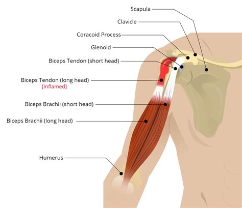 Biceps Tendinopathy Physiotherapy London Ontario