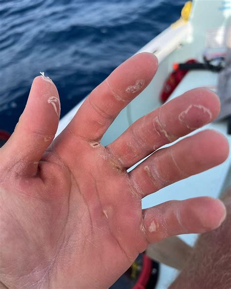 About Mel Eissens Solo Ocean Rower Hands Atlantic