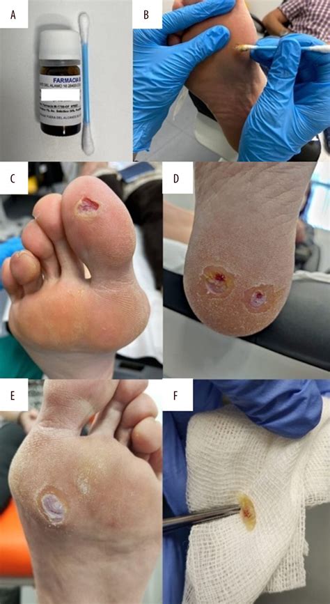 Salicylic Acid Plantar Warts