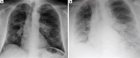 Figure From Sars Cov Lung Disease In A Patient With Pulmonary