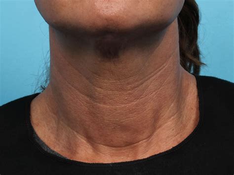Before And After Laser Skin Tightening Photos