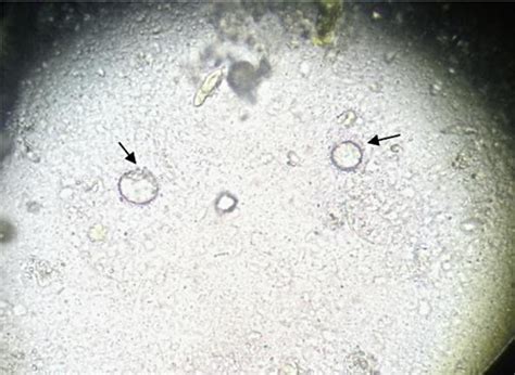 Figure From Blastocystis Hominis And Endolimax Nana Co Infection