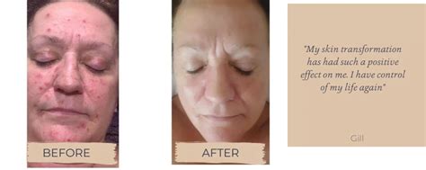 Real Results Another Skin Transformation Jan Bromley Beauty