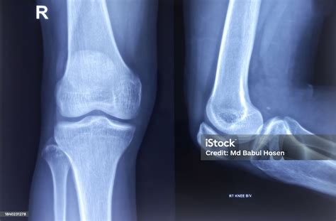 knee joint xray ap  lateral view normal skeletal normal findings