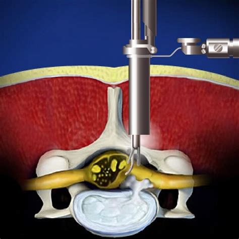 Herniated Disc Epic Pain Management