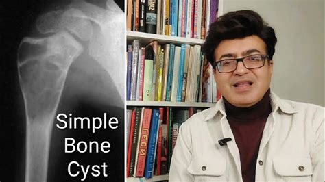 Review Of Simple Bone Cyst Radiology Xrays And Ct Images Youtube