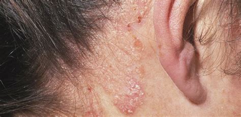 Plaque Psoriasis Ear