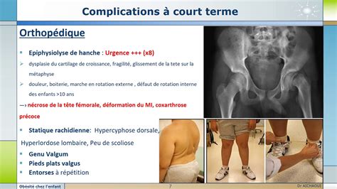 obésité chez l enfant et l adolescent 4 complications YouTube