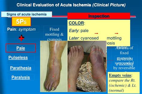 Ppt Peripheral Arterial Disease Pad Powerpoint Presentation Free