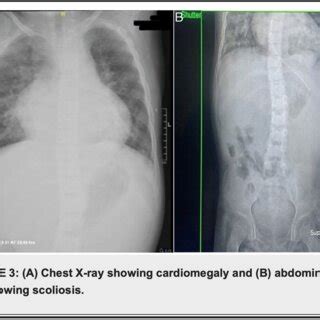 A Chest X Ray Showing Cardiomegaly And B Abdominal Xray Showing