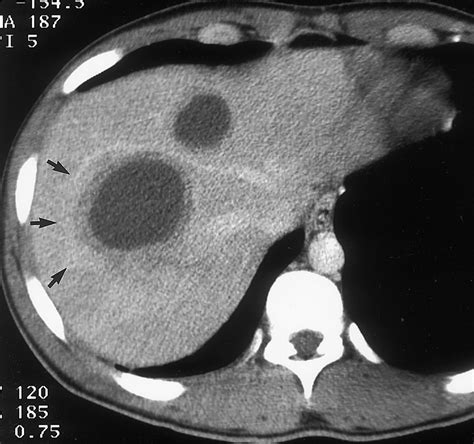 Cystic Focal Liver Lesions In The Adult Differential Ct And Mr Imaging