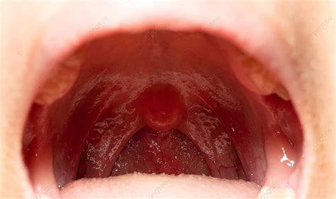 Closeup Of Swollen Throat And Open Mouth With Posterior View Indicating