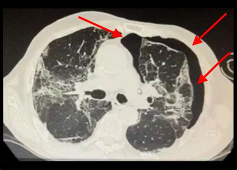 American Journal Of Case Reports Spontaneous Pneumomediastinum And