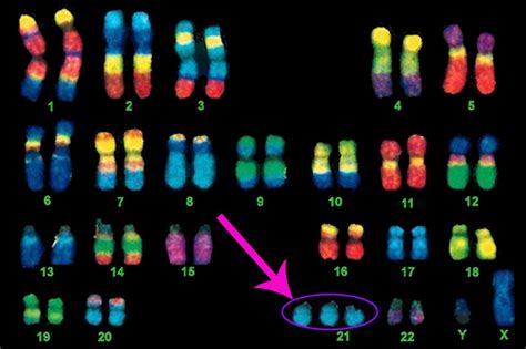 What Is Down syndrome? The 21st Chromosome Simply Explained