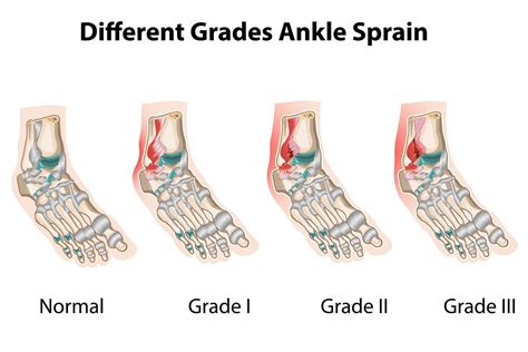 Lateral Ankle Ligament Sprains: Symptoms & Treatment – Injury Health Blog