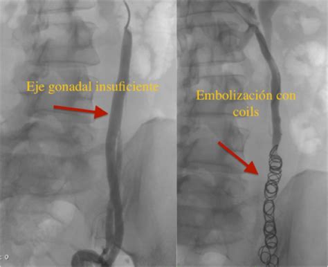tratamientos varices pelvicas varicocele rodriguezmorata
