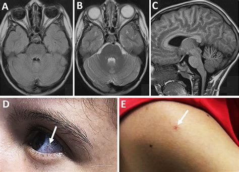 Ataxia Telangiectasia Mri