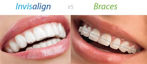 Invisalign Vs Ceramic Braces