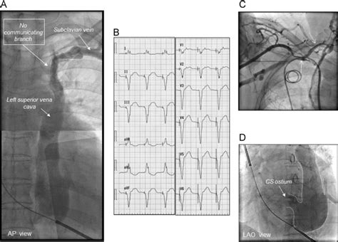 A Venogram From The Left Subclavian Vein Showing The Persistent Left Download Scientific