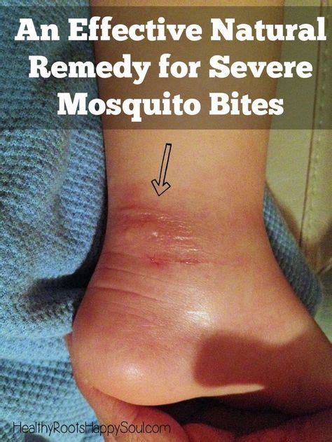 An Effective Natural Remedy For Severe Mosquito Bites Remedies For