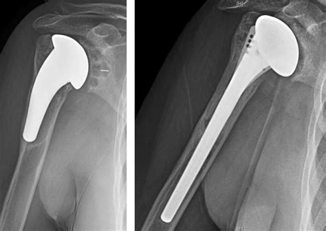 Uw Shoulder And Elbow Academy Treatment Of Glenoid Component Loosening In Anatomic Shoulder