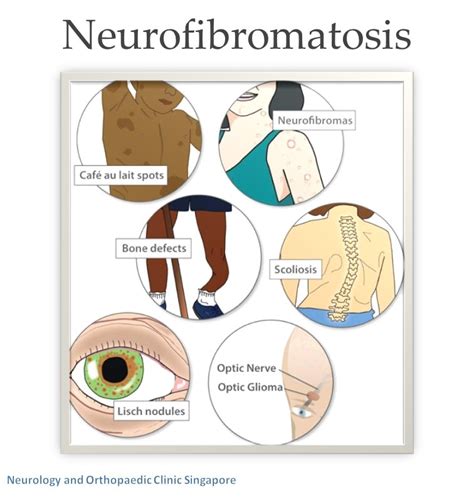 Axillary Freckling In Neurofibromatosis