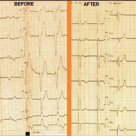 Twelve Lead Electrocardiogram At Baseline BEFORE And Following Left