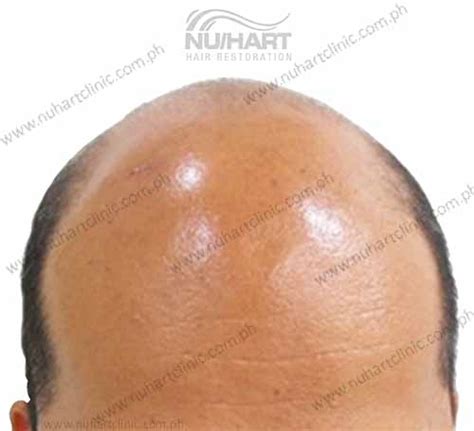 Nuhart1 Nuhart Hair Restoration Philippines