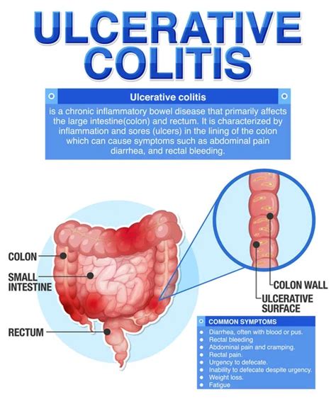 Peptic Ulcer Disease Explained Infographic Illustration Stock Vector By ©blueringmedia 645541048