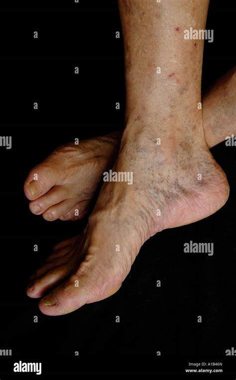 Deep Vein Thrombosis Foot