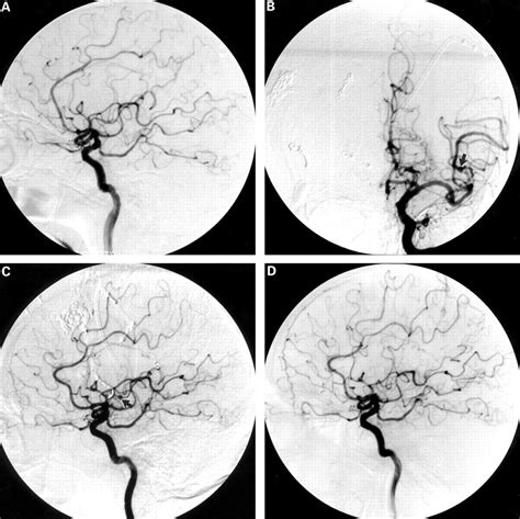 Cerebral Aneurysms Associated With Behçets Disease A Case Report Journal Of Neurology